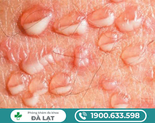 MỤN NƯỚC Ở VÙNG KÍN NỮ